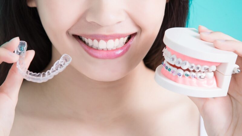 5 Reasons Why Adults Should Choose Clear Aligners over Braces