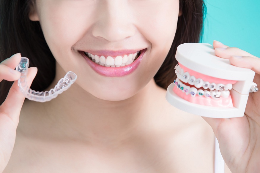 5 Reasons Why Adults Should Choose Clear Aligners over Braces